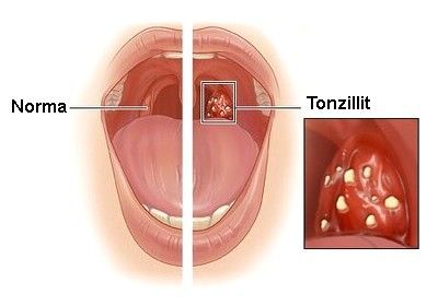 Anginanın xalq təbabəti üsulları ilə müalicəsi