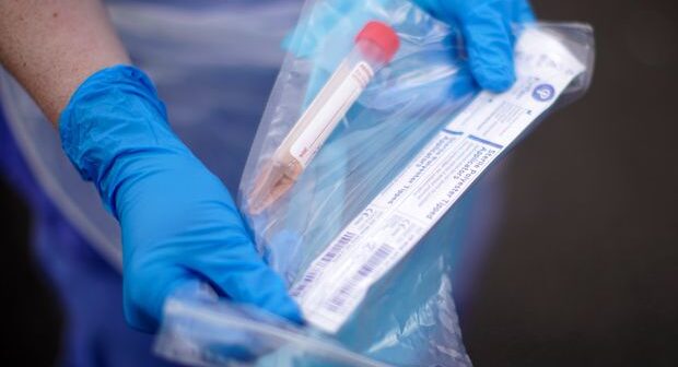Azərbaycanda daha 75 nəfərdə koronavirus aşkarlandı – RƏSMİ