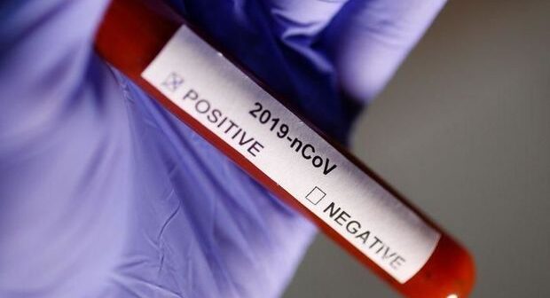 Bu gün Azərbaycanda daha 315 nəfərdə koronavirus aşkarlandı, beş nəfər vəfat etdi
