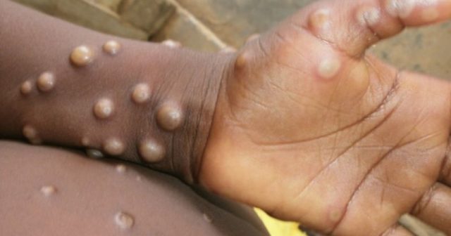 ÜST: Afrikada ilin əvvəlindən 70-ə yaxın insan meymunçiçəyi xəstəliyindən ölüb