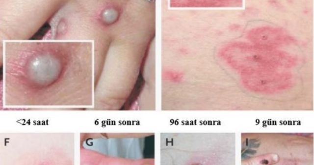 Hindistanda meymunçiçəyinə ilk yoluxma halı təsdiqlənib
