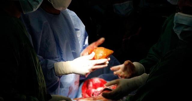 Dünyanın ən böyük böyrək daşı çıxarıldı: 801 qram