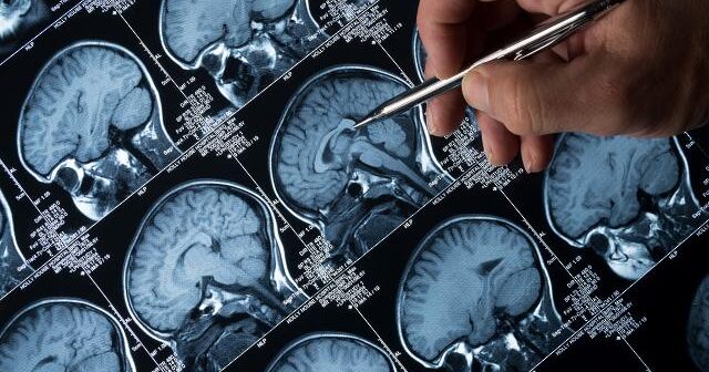 Alzheimerin müalicəsində əhəmiyyətli irəliləyiş: Xəstəliyin gedişatını yavaşlatmaq olar