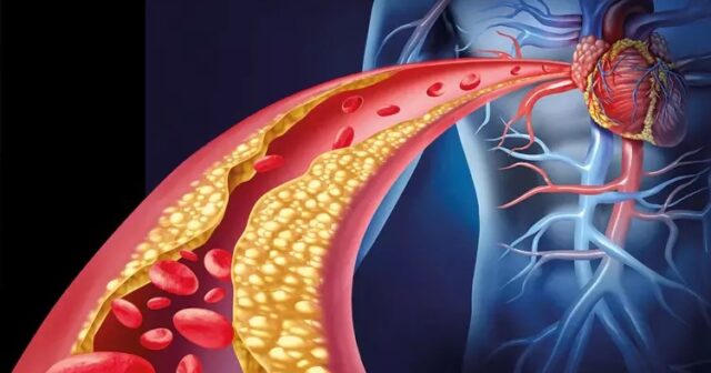 Ürək-damar xəstəlikləri ilə mübarizədə yenilik – bu, xolesterini aşağı salacaq