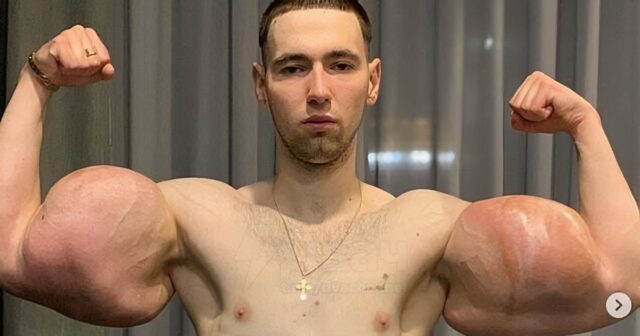 “Bazuka qolları” ilə məşhurlaşan gəncin qolu ÇÜRÜYÜR – FOTO/VİDEO “Bazuka qolları” ilə məşhurlaşan gəncin qolu ÇÜRÜYÜR – FOTO/VİDEO