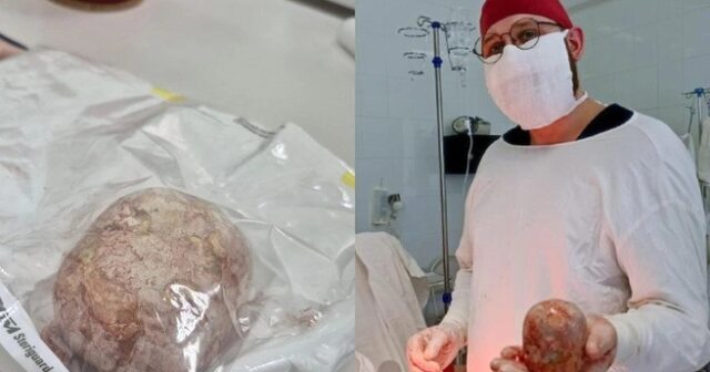 Xəstənin böyrəyindən 1 kiloqramlıq nəhəng daş ÇIXARILDI – FOTO