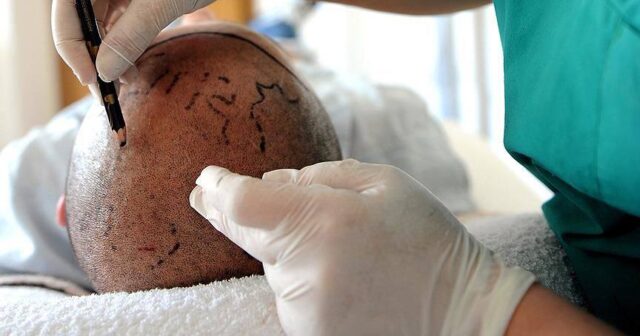 Britaniyalı İstanbulda saç əkdirmə prosedurundan sonra DÜNYASINI DƏYİŞDİ – FOTO