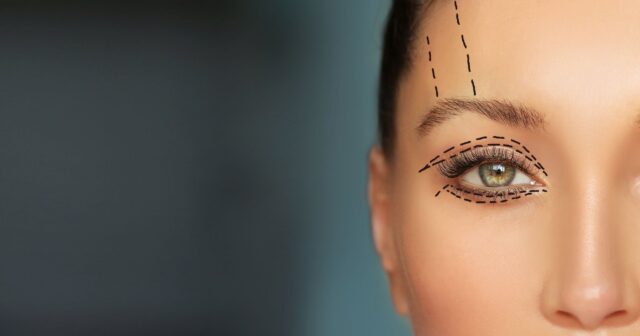 Uğursuz blefaroplastika: Ucuz əməliyyatdan sonra qadının gözləri AÇIQ QALIB – FOTO Uğursuz blefaroplastika: Ucuz əməliyyatdan sonra qadının gözləri AÇIQ QALIB – FOTO