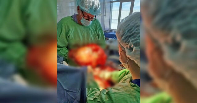 Nəfəs almaqda çətinlik çəkən ahıl qadının bədənindən 18 kq-lıq ŞİŞ ÇIXARILDI