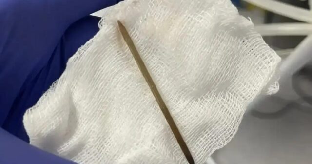 Toyuq filesi ilə udduğu diş çöpü bir ay sonra kişinin mədəsini DEŞDİ – FOTO Toyuq filesi ilə udduğu diş çöpü bir ay sonra kişinin mədəsini DEŞDİ – FOTO