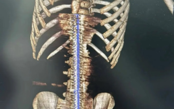 Metal çubuq yeniyetmənin bədənini DEŞDİ: Ürəyinə bir santimetr QALDI – FOTO Metal çubuq yeniyetmənin bədənini DEŞDİ: Ürəyinə bir santimetr QALDI – FOTO