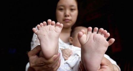 31 barmağı olan uşaq doğuldu – fotolar