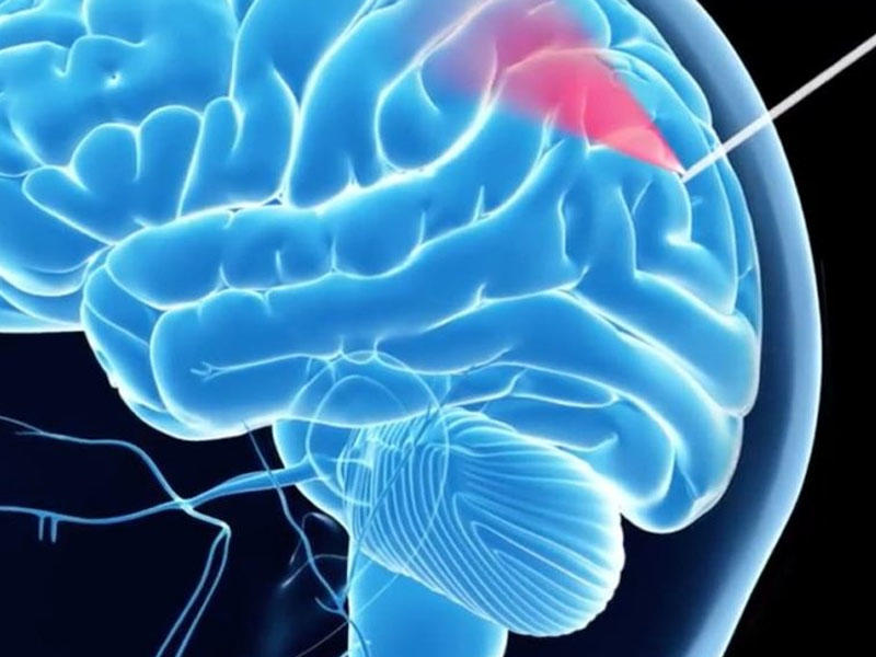Beyin biopsiyası üçün kameralı “ağıllı” iynə yaradılıb
